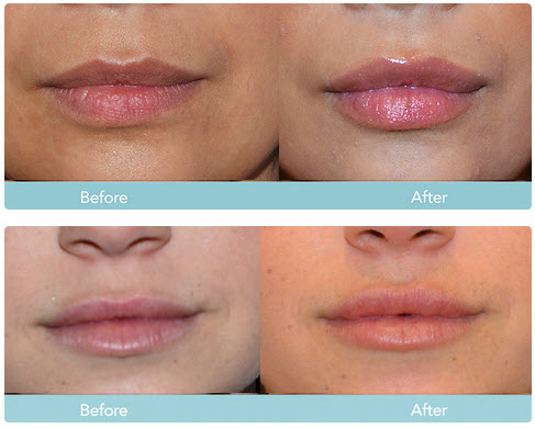 juvederm lips syringe before much filler services face often injected areas