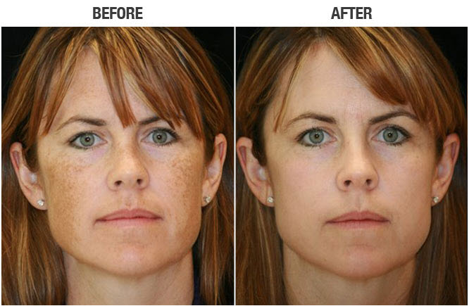 Ipl Photofacial Ipl Foto Facial San Diego