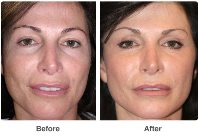 Laser Skin Resurfacing San Diego