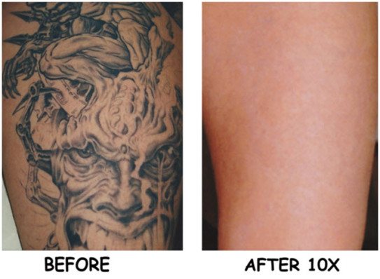 Laser Tattoo Removal | Laser Tattoo Removal Cost